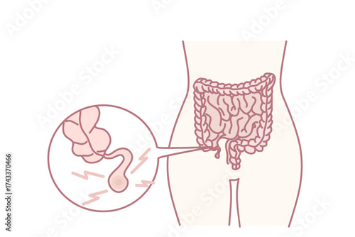 Closeup of human body with inflamed appendix. Person suffer from appendicitis need surgery. Vector illustration.