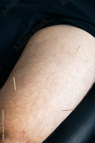 Macro shot of dry needling acupuncture needles inserted in male leg muscle.