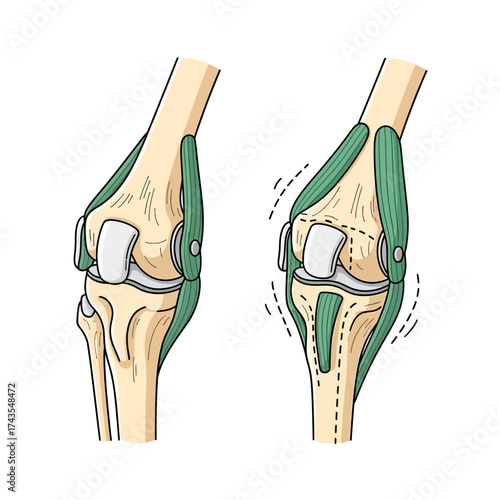 Anatomical illustration comparing a healthy knee joint with a knee joint undergoing surgical repair.