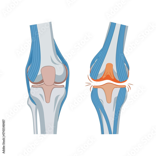 Medical vector illustration comparing a healthy human knee joint to one damaged by osteoarthritis, showing cartilage erosion.