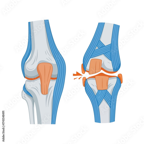 Illustration showing a healthy knee joint compared to a damaged knee joint with torn ligaments and cartilage.