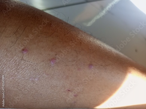 Close up of Human Skin with Eczema Dermatitis Condition