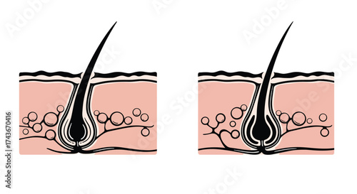 Illustration of a hair follicle showing healthy and blocked pores