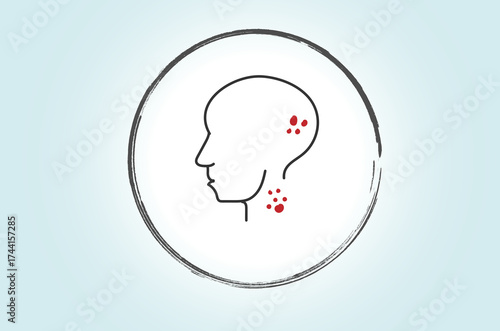 Head and neck cancer refers to malignant tumors that develop in the mouth, throat, larynx, nose, or other nearby structures, often requiring surgery, radiation, or chemotherapy for treatment