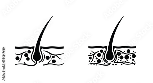 Illustration showing hair follicles one normal and one clogged with buildup