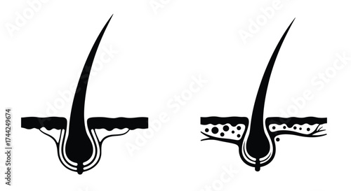Illustration of two human hair follicles showing different root structures