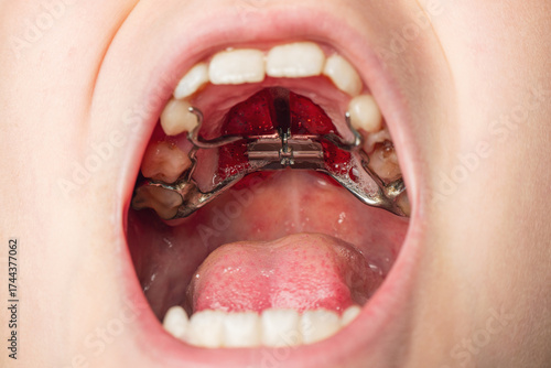 Palatal expander dental device in mouth. Medical and orthodontic equipment inside oral cavity
