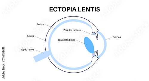 Ectopia lentis disease