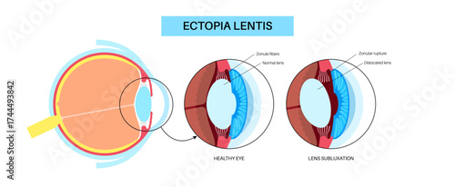 Ectopia lentis disease