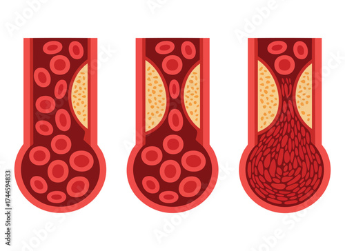 Cholesterol blocked and normal artery vector illustration showing thrombus blood clot atherosclerotic plaque deep vein thrombosis DVT blood vessel circulation
