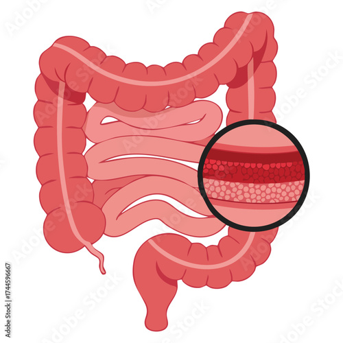 Vector illustration of colonoscopy procedure showing intestine polypectomy and polyp removal perfect for colon checkup surgery and medical health education