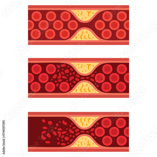 Vector illustration of normal and cholesterol blocked artery with thrombus blood clot atherosclerotic plaque DVT deep vein thrombosis and vascular flow concept