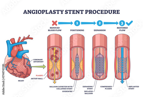 Angioplasty stent procedure shows heart, artery, and stent placement to restore blood flow, transparent background.