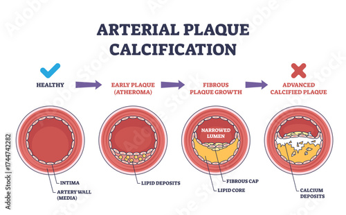Arterial plaque calcification shows artery cross-sections with plaque buildup, narrowed lumen, and calcium deposits, transparent background.