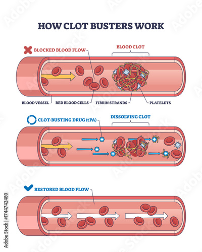 Clot busters work by dissolving blood clots in vessels, restoring blood flow, key objects, blood clot, drug, blood vessel, transparent background.