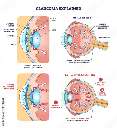 Glaucoma diagram shows impaired drainage, pressure buildup, and optic nerve damage in the eye, transparent background.Key objects, optic nerve, trabecular meshwork, aqueous humor.