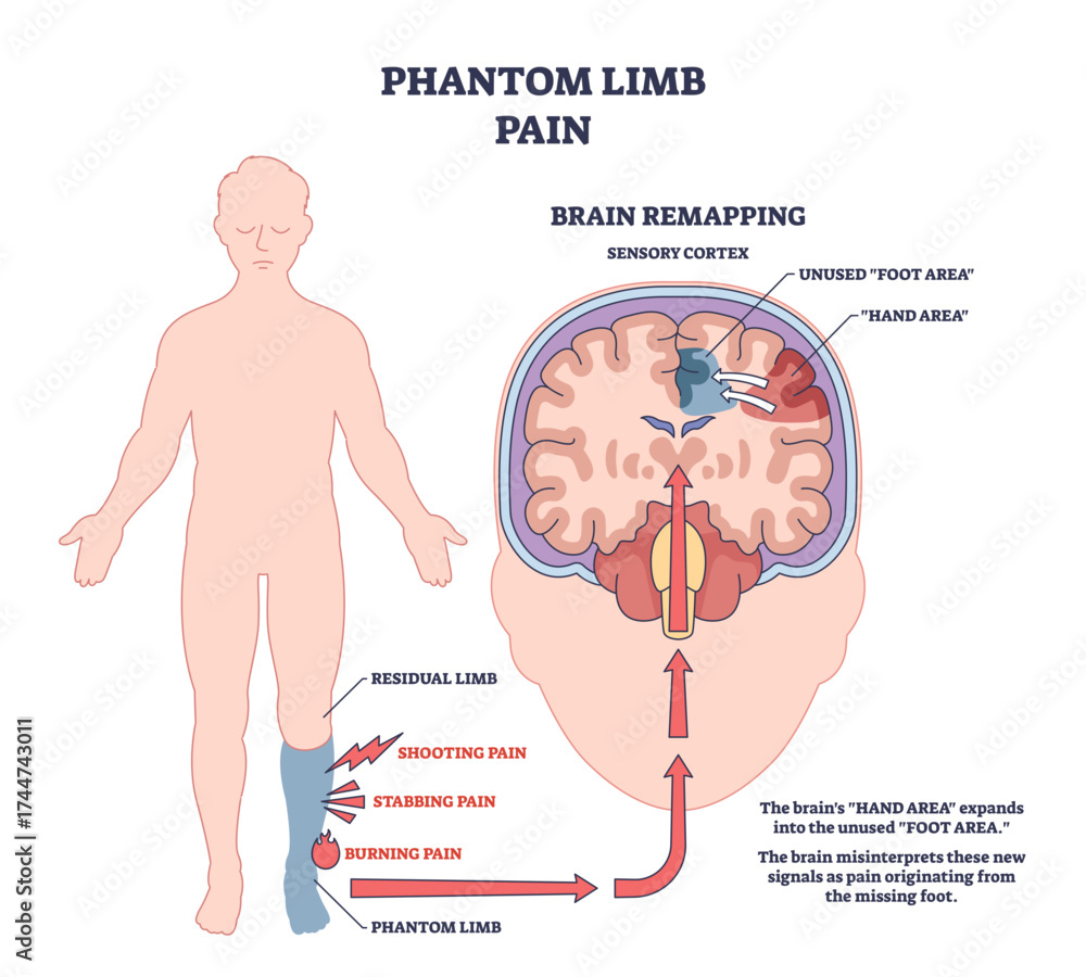Obraz premium Phantom limb pain is shown with a human figure, brain diagram, and pain signals to illustrate brain remapping after limb loss, transparent background.