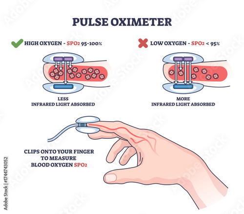 Pulse oximeter diagram shows how a fingertip device measures blood oxygen levels using light absorption, transparent background.Key objects, finger, sensor, blood vessel.