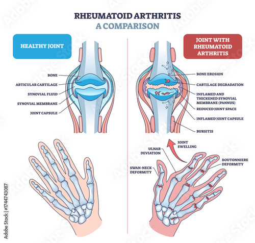Rheumatoid arthritis diagram shows a comparison between healthy and affected joints, highlighting bone erosion, cartilage loss, and joint swelling, transparent background.