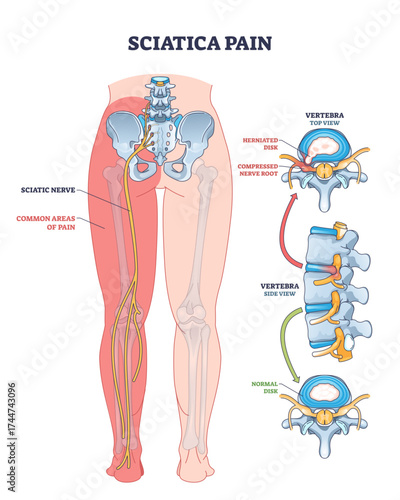 Sciatica pain is shown with highlighted nerve, pain areas, and spine structure, illustrating causes and affected regions, transparent background.