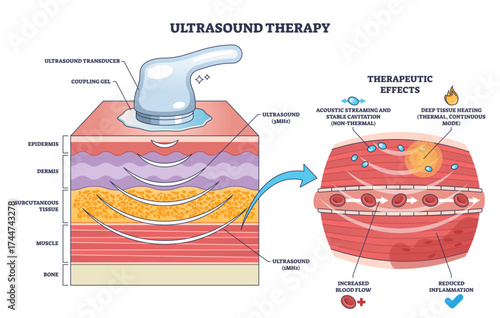 Ultrasound therapy diagram shows a transducer applying sound waves to tissue layers, illustrating deep tissue effects and therapeutic benefits, transparent background.