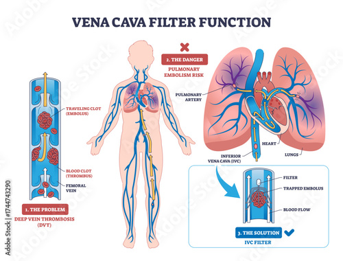 Vena cava filter diagram shows blood clot prevention in veins, highlighting filter, blood flow, and clot, transparent background.