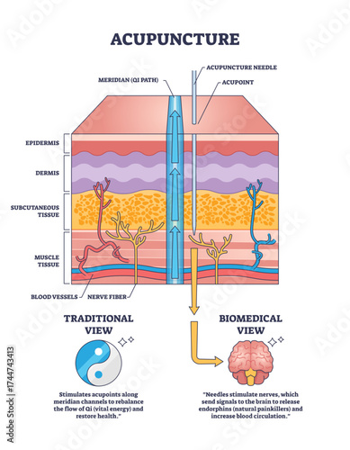 Acupuncture diagram shows needle insertion, meridian path, and skin layers, illustrating traditional and biomedical views, transparent background.