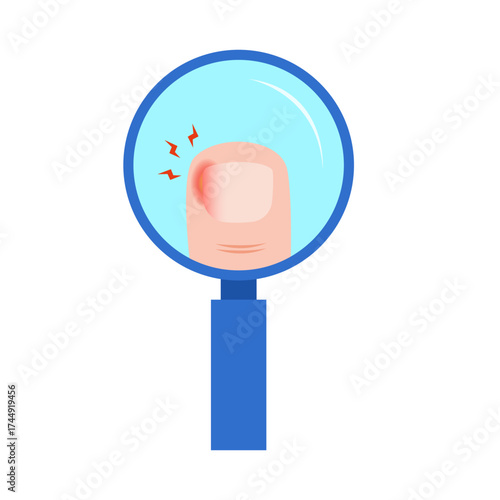 Ingrown Toenail on Foot. vector illustration