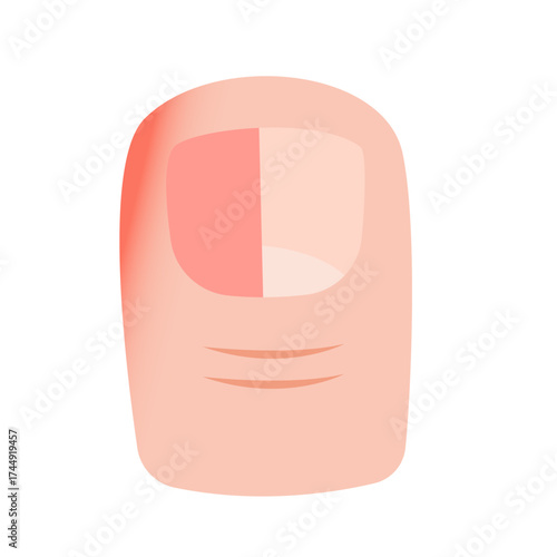 Ingrown Toenail on Foot. vector illustration