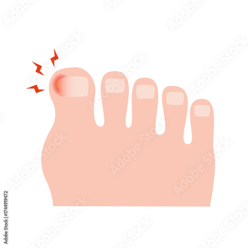 Ingrown Toenail on Foot. vector illustration