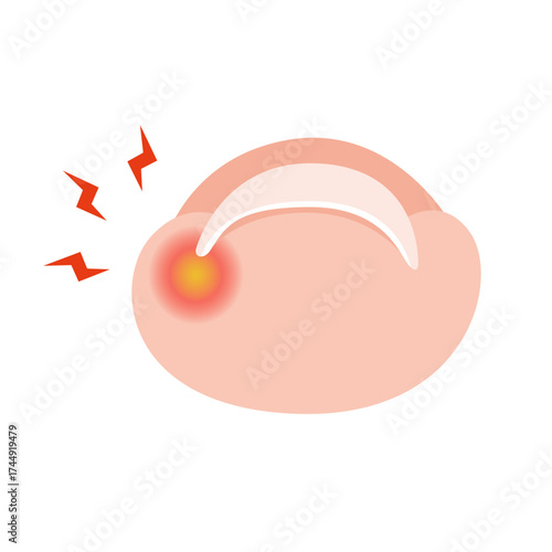 Ingrown Toenail on Foot. vector illustration