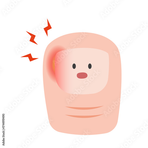Ingrown Toenail on Foot. vector illustration