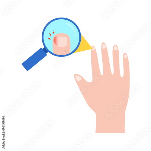 Ingrown Toenail on Foot. vector illustration