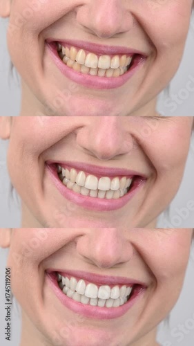 Caucasian woman smiling. Before and after teeth whitening.