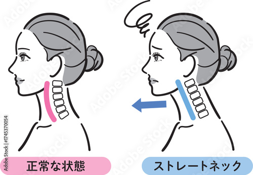 正常な状態とストレートネックの比較イラスト（女性横顔）