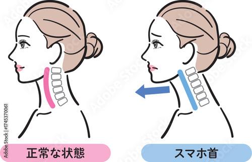 正常な状態とスマホ首の比較イラスト（女性横顔）