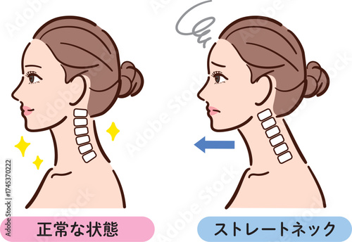 正常な状態とストレートネックの比較イラスト（女性横顔）