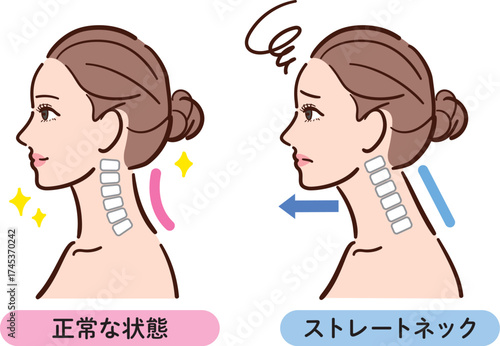 正しい姿勢とストレートネックの比較イラスト（女性横顔）