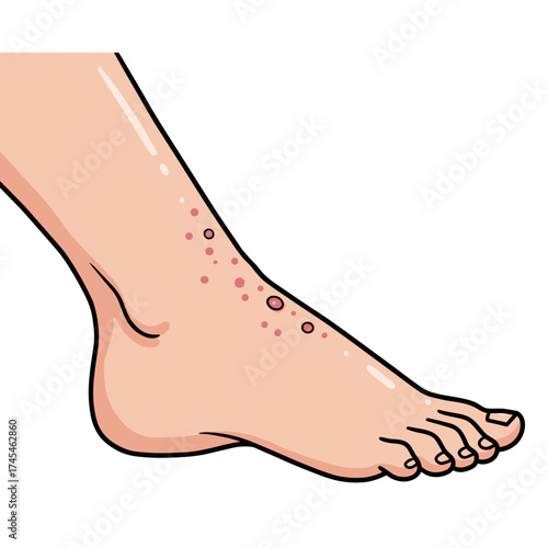 Human foot with skin rash highlighted in detailed illustration  