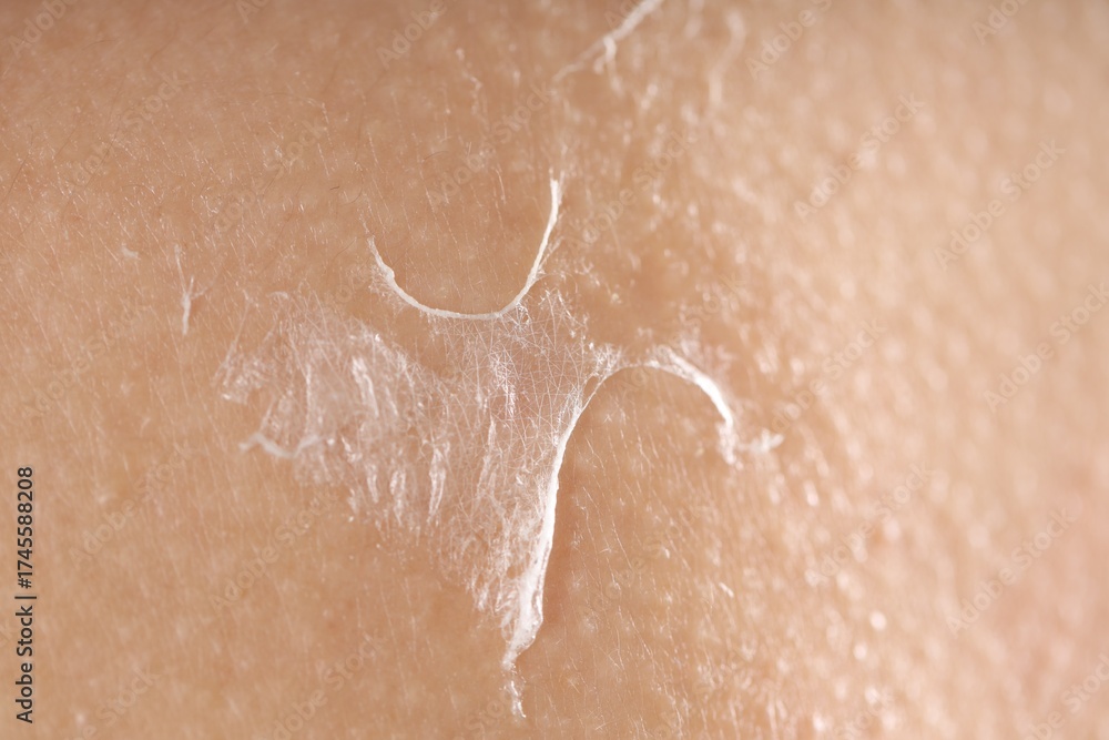 Fototapeta premium Closeup view of woman with dry skin