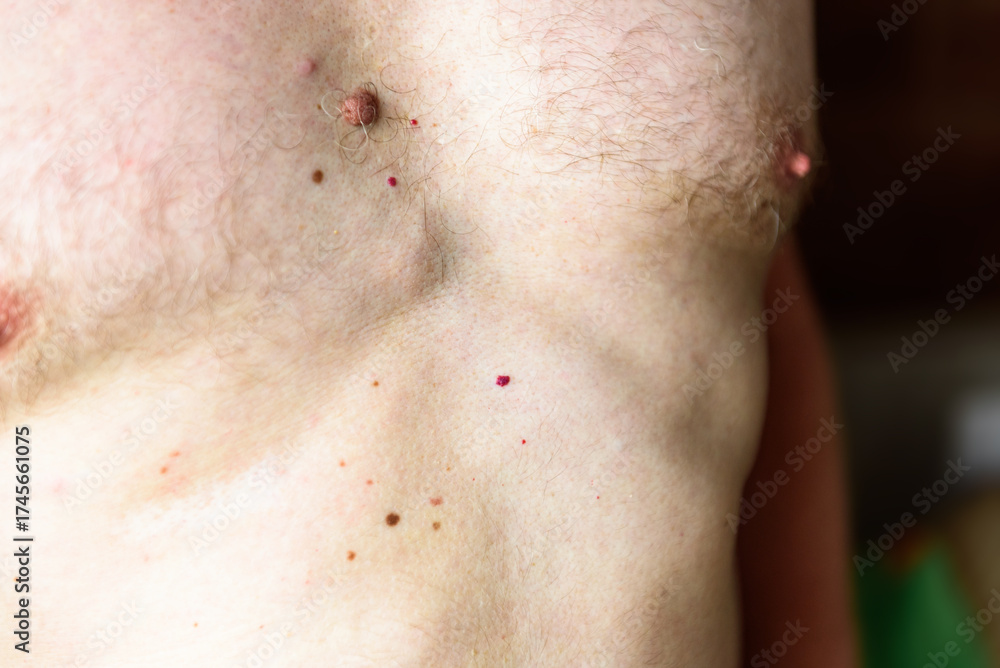 Fototapeta premium Lipomatosis or Dercum's disease (neurolipomatosis) on the man's abdomen. Foci of overgrown fatty tissue.