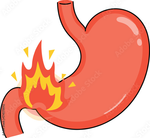 Human stomach with acid reflux, burning pain, digestive problem illustration, gastritis inflammation, heartburn concept, medical anatomy, healthcare education graphic