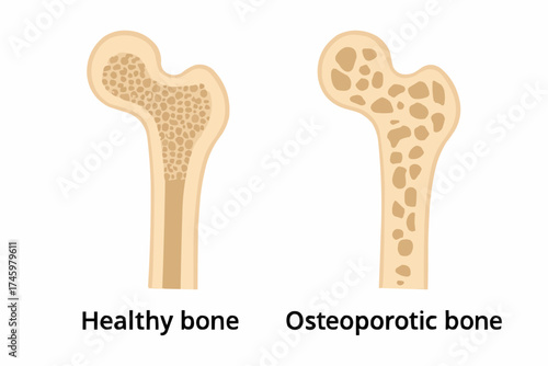 Comparison of Healthy and Osteoporotic Bone Structure Vector