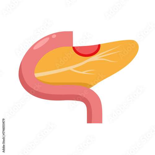 Anatomy Of Pancreatitis Flat Illustration 