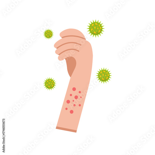 Illustration Of Hand With Measles