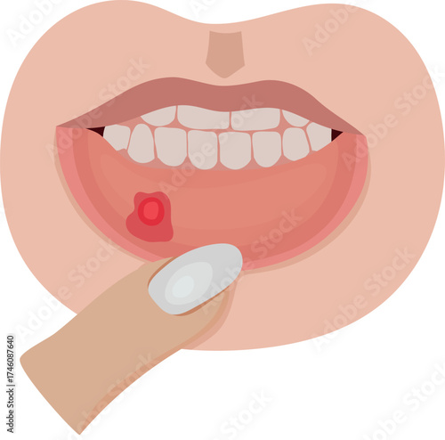 Ulcer or Stomatitis on Lower Lip Illustration Isolated on White Background