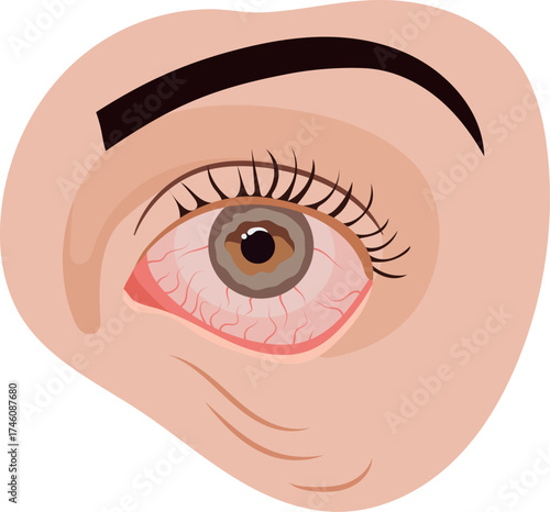 Reddened Eye with Blood Vessel Illustration Isolated on White Background
