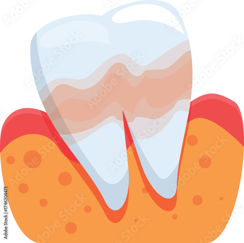 Medical illustration showing periodontitis damaging tooth enamel and causing gum inflammation