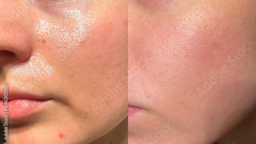 Photos Visible transformation of oily facial skin to smooth surface in macro view