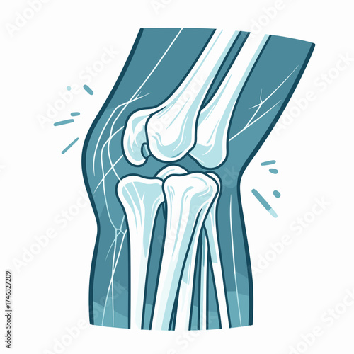 X-ray of fractured bone
